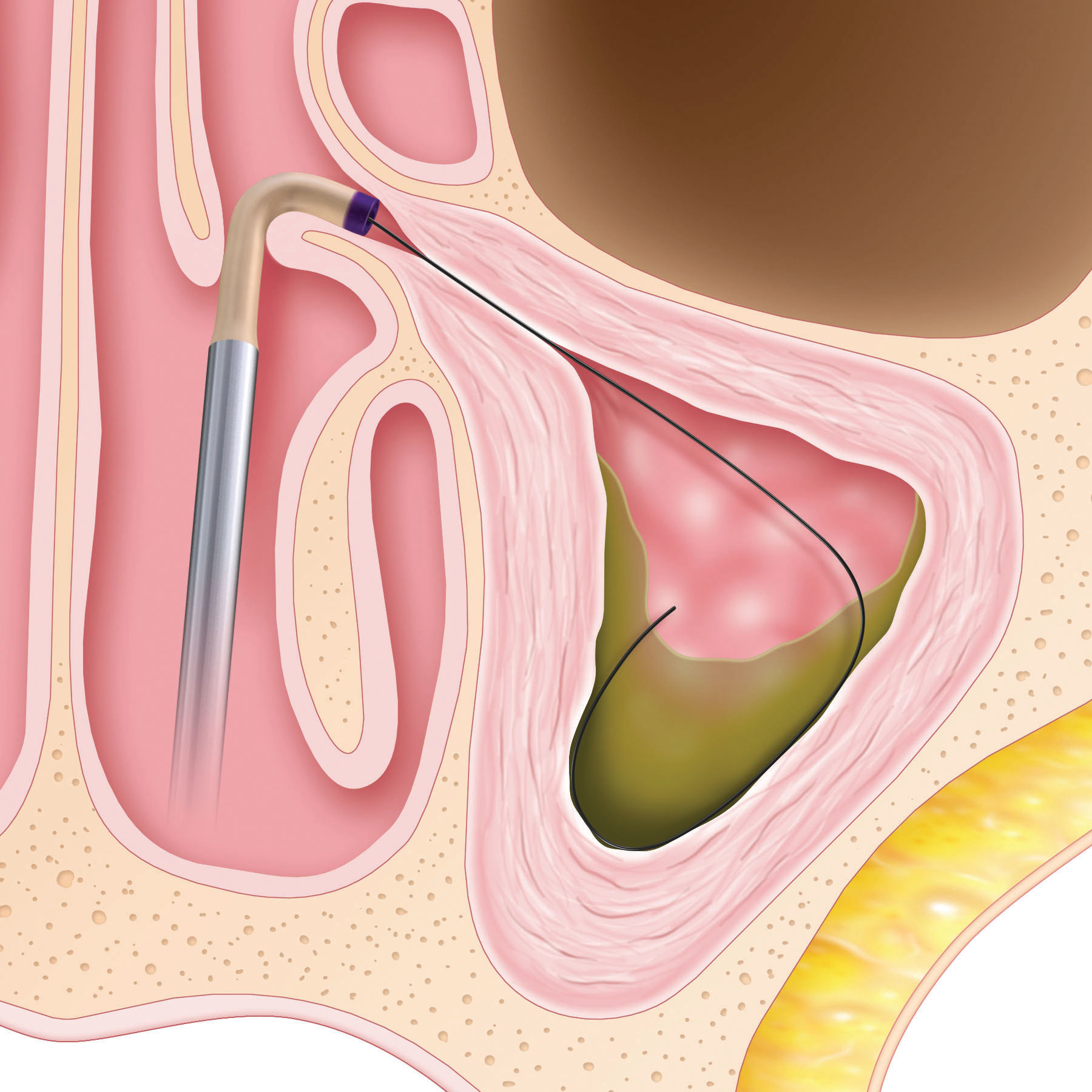 Graphic of sinus for step 1 of Baloon Sinuplasty.